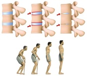 bechterevova choroba nemoc byliny bylinky babske rady caj koupel mast mazani